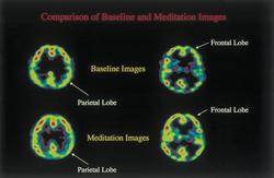 Comparison of Baseline and Meditation Images.jpg